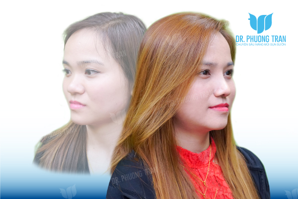 Ngọc Nguyễn: Việt kiều Đài Loan nhất định chỉ nâng mũi bởi Dr. Phương