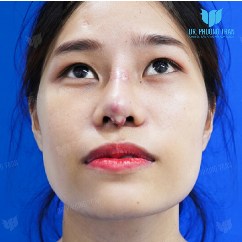 4 dấu hiệu bị mưng mủ thường gặp nhất sau phẫu thuật nâng mũi