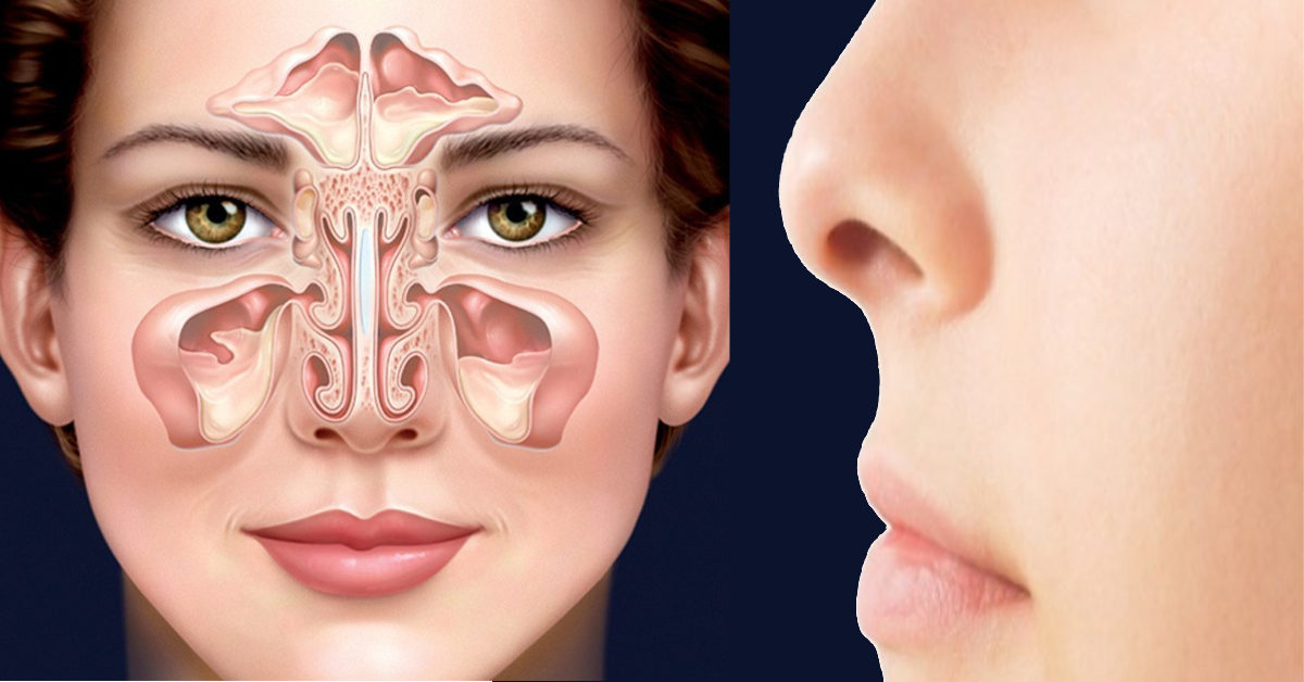 Nâng mũi bị chảy nước mũi có ảnh hưởng đến kết quả nâng mũi không?