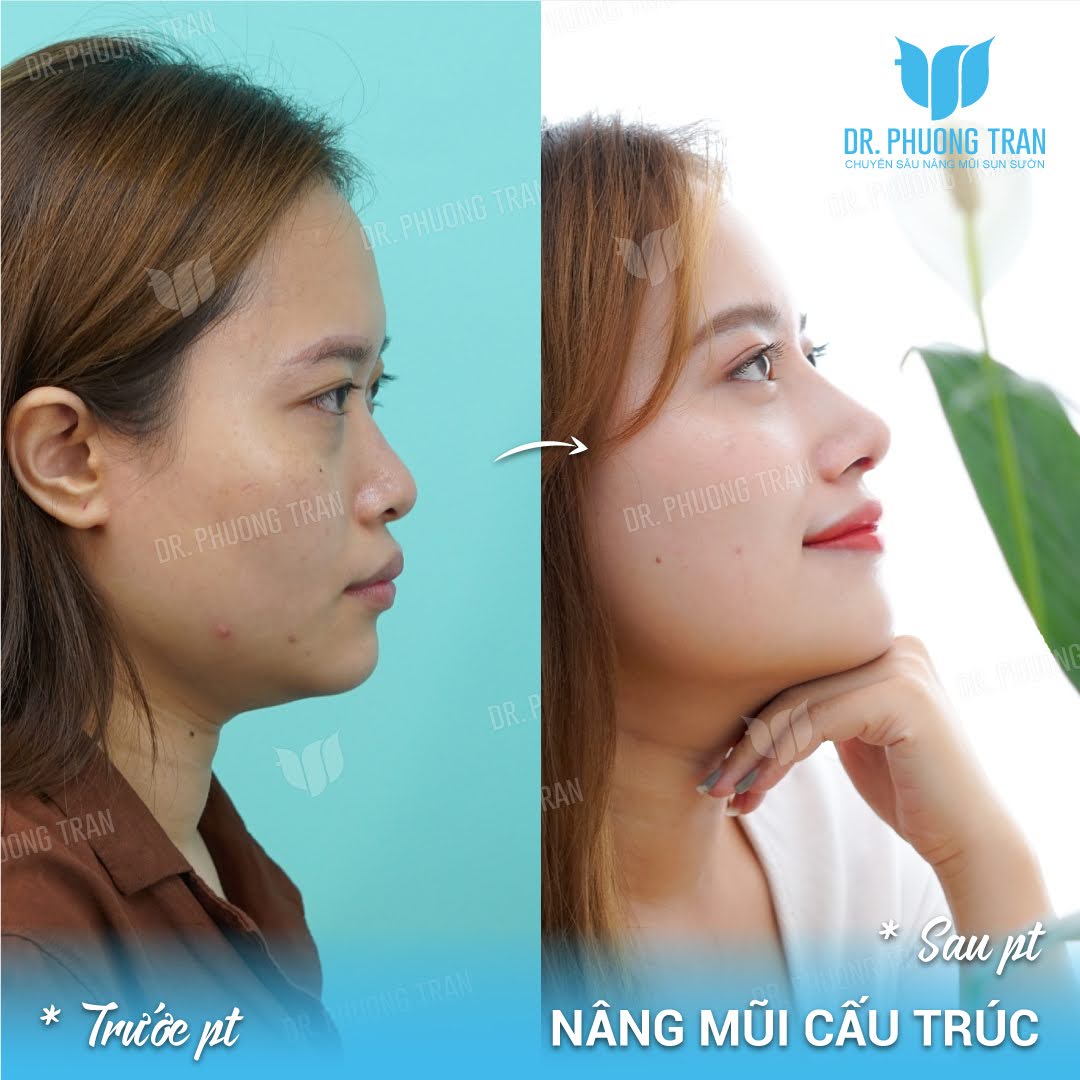 Những tiêu chí để lựa chọn bác sĩ nâng mũi đẹp ở Hà Nội và TPHCM