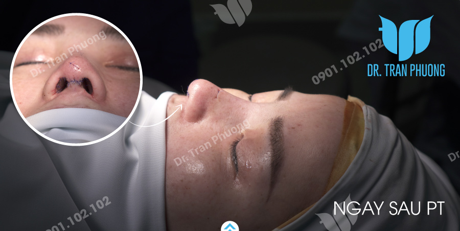 Khi nào cần cắt chỉ sau nâng mũi? Quá trình cắt chỉ có đau không?