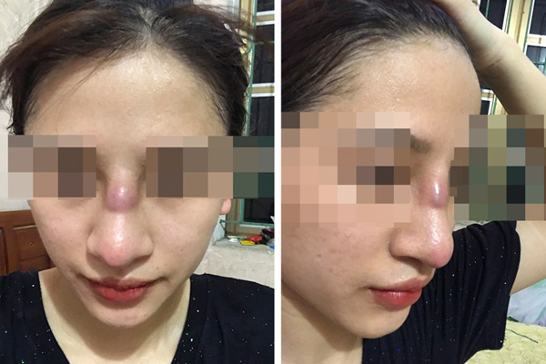 Cô gái Quảng Ninh nhiễm trùng mũi vì tin quảng cáo mạng