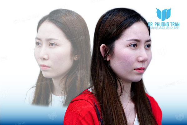 Mộng Thùy: Giải cứu dáng mũi lệch từ ca nâng mũi tại Đài Loan