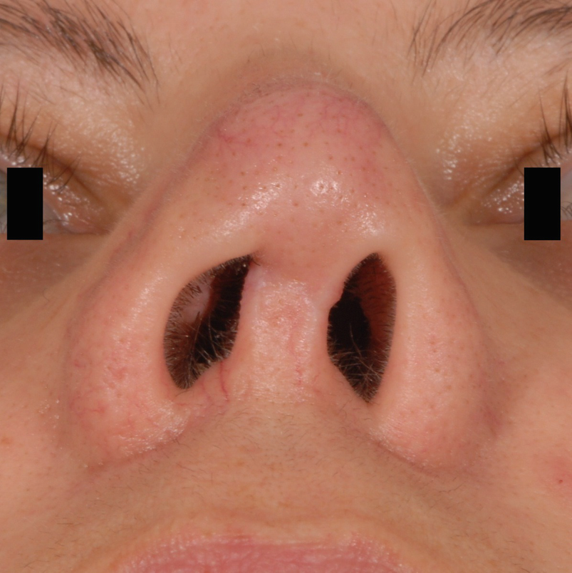 Các tình trạng có thể gặp ở trụ mũi và cách xử lý sửa trụ mũi tốt nhất