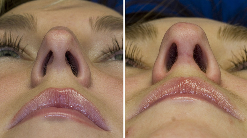 Các tình trạng có thể gặp ở trụ mũi và cách xử lý sửa trụ mũi tốt nhất