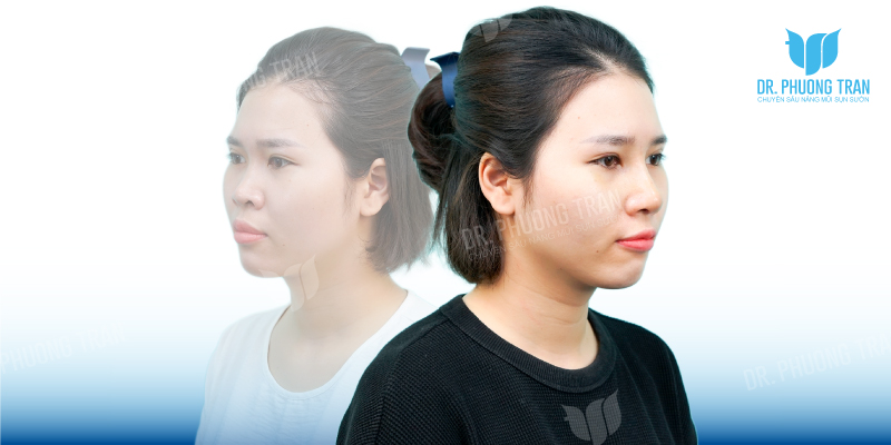 Kim Hiền: Dáng mũi đẹp tự nhiên sau 2 tuần nâng mũi sụn sườn