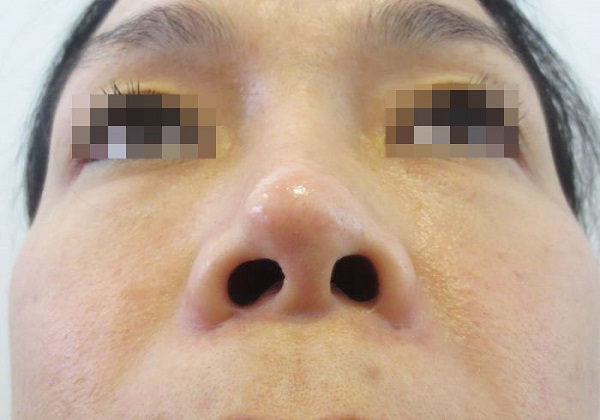 Tụt sụn sau khi nâng mũi: Nguyên nhân và cách xử lý