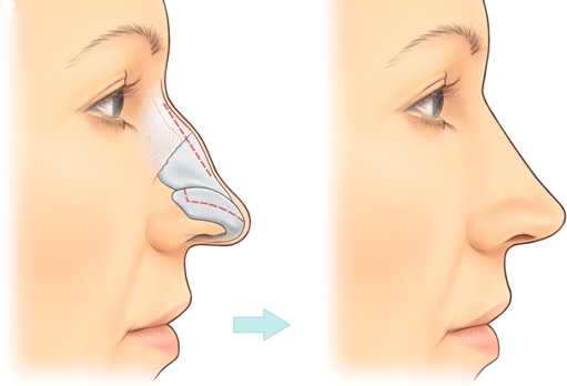 Đầu mũi bị dài có đặc điểm gì? Làm sao để khắc phục khuyết điểm này?