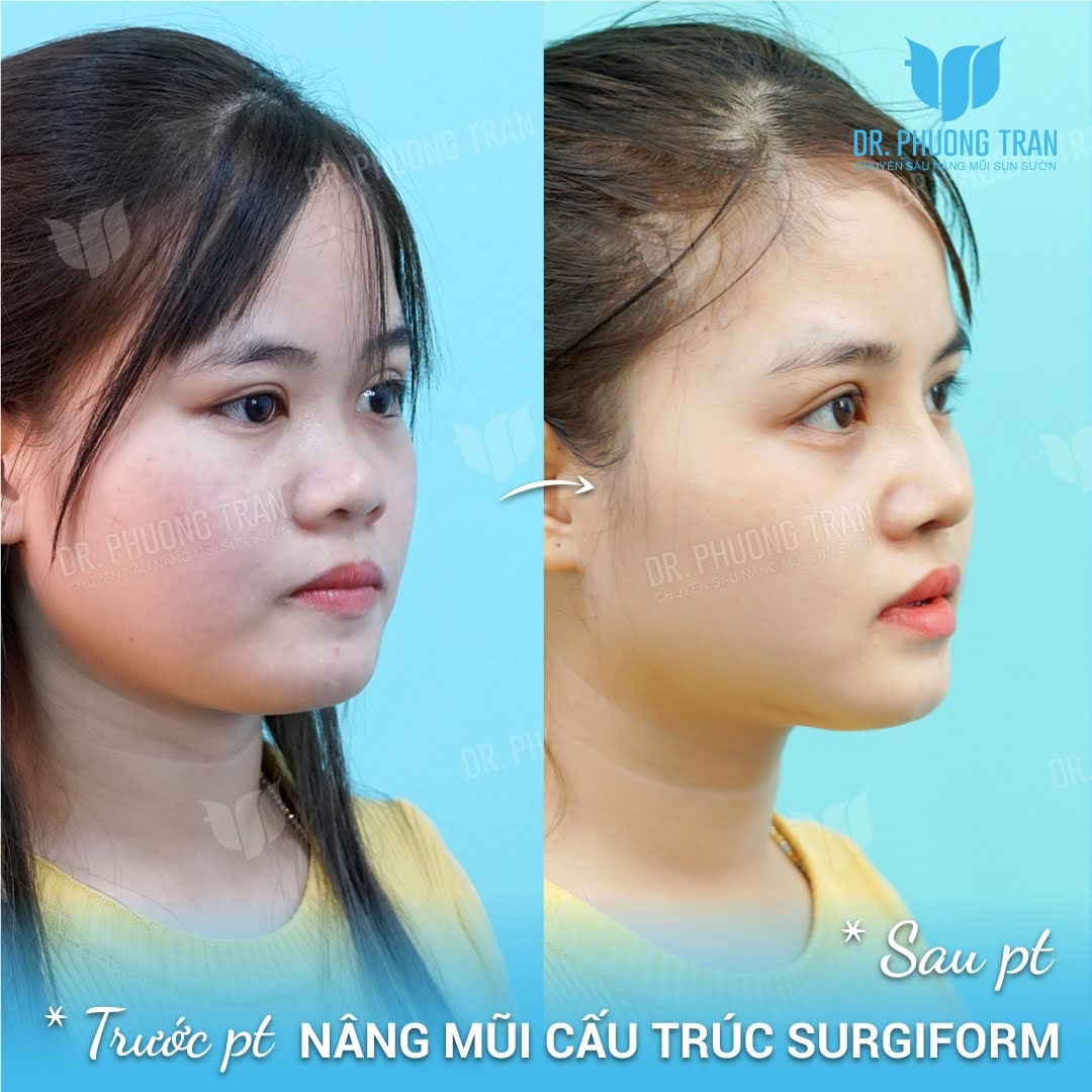 Hìոh ảոh kháсh hàոg nâng mũi surgiform tại Dr Trần Phương